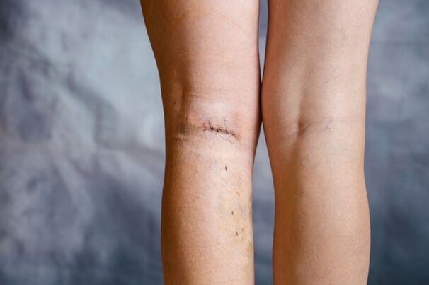 կարել ոտքի վրա վիրահատությունից հետո varicose veins