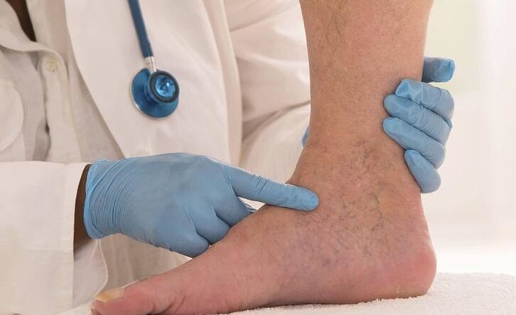 բժիշկը ոտքը զննում է varicose veins- ով