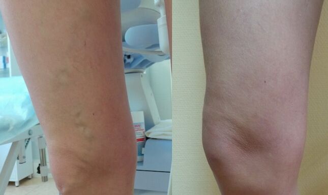 ոտքը ցանցային վարիկոզի բուժումից առաջ և հետո