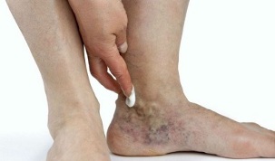 ոտքերի վրա varicose veins- ի դրսեւորումները